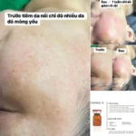 Tiêm Meso Trị Nám: Giải Pháp Làm Đẹp Hiệu Quả Cho Làn Da Sáng Mịn