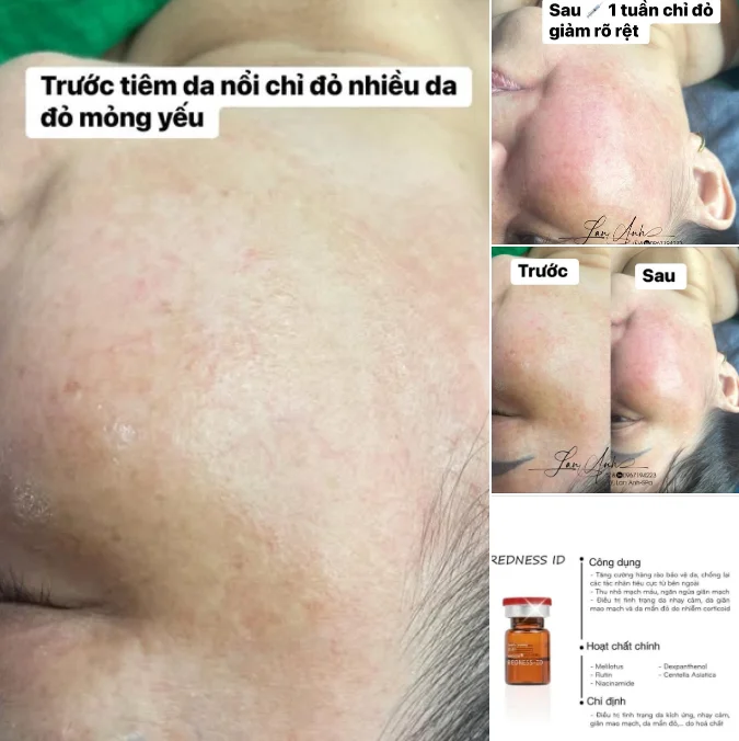 review-tiem-meso-tri-nam-mun-phot